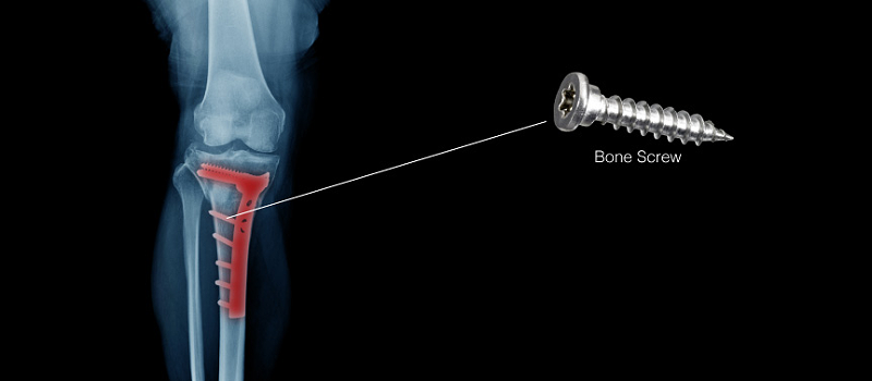 医疗骨钉加工<a href='/gaosuzhuzhou.htm' class='keys' title='点击查看关于高速主轴的相关信息' target='_blank'>高速主轴</a>彩博888.png